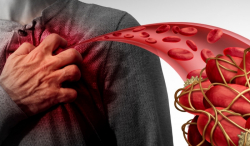 Ковид19 халдварын дараа цус өтгөрснөөр зүрхний шигдээсээр өвдөх эрсдэлтэй