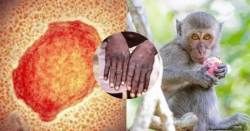 БНСУ-д сармагчны цэцэг өвчний хоёр тохиолдол бүртгэгдсэн