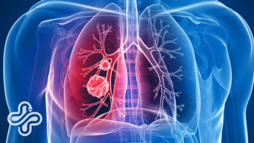 Уушгины хатгалгаа өвчний шинж тэмдгийг хэрхэн таних вэ?