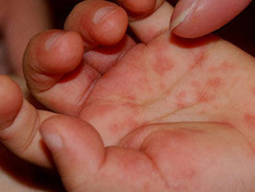 Урин дулааны улиралд гар, хөл, амны өвчнөөс сэргийлье